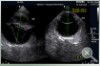 Ultrassonografia Oftalmica
