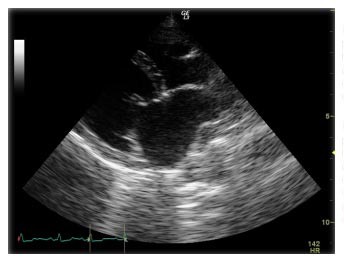 Ecocardiografia Morfológica Bidimensional 